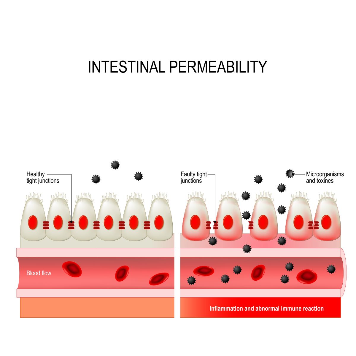 Leaky Gut- Intestinal Permability