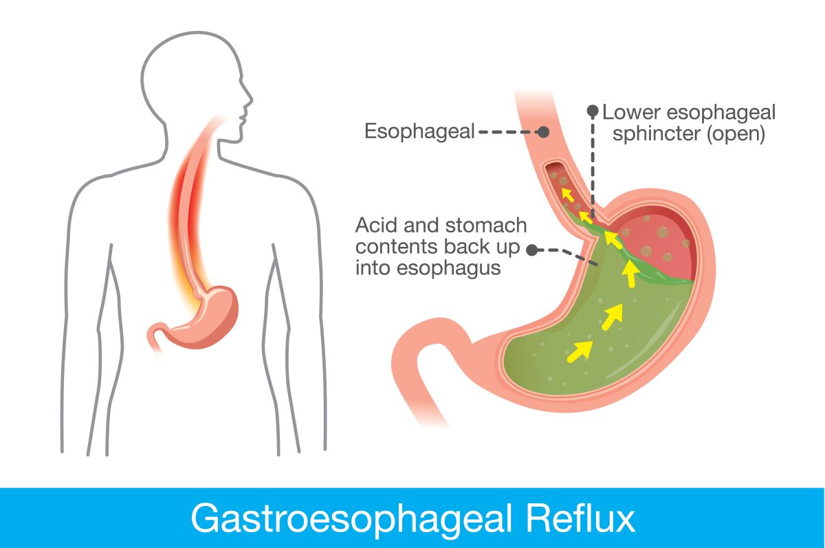 Gastroesophageal Reflux